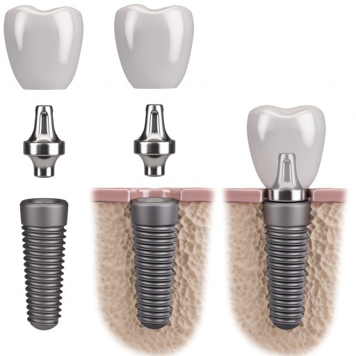 Implantace zubních implantátů